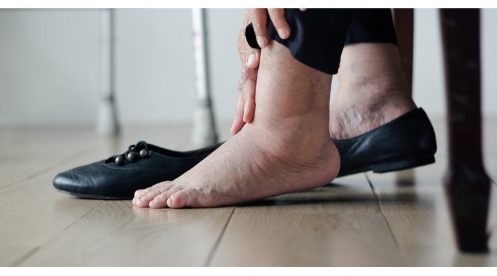Piedi gonfi, cause e rimedi